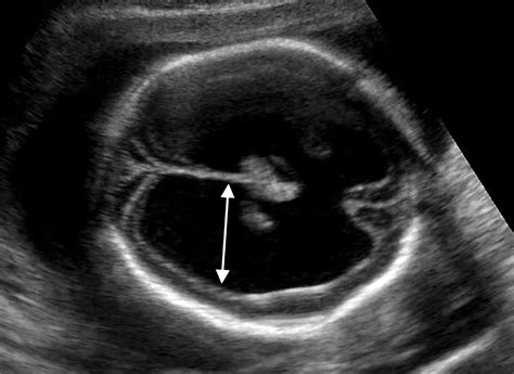 mega cisterna magna prognosis|Abnormalities of the Fetal Central Nervous System: Prenatal US.
